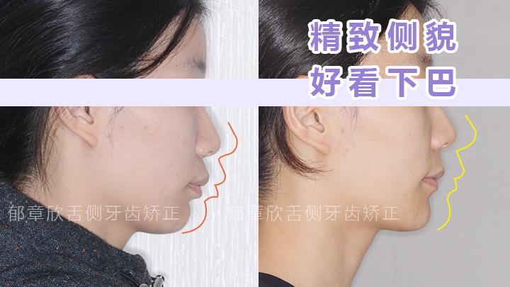 下巴后縮如何矯正
