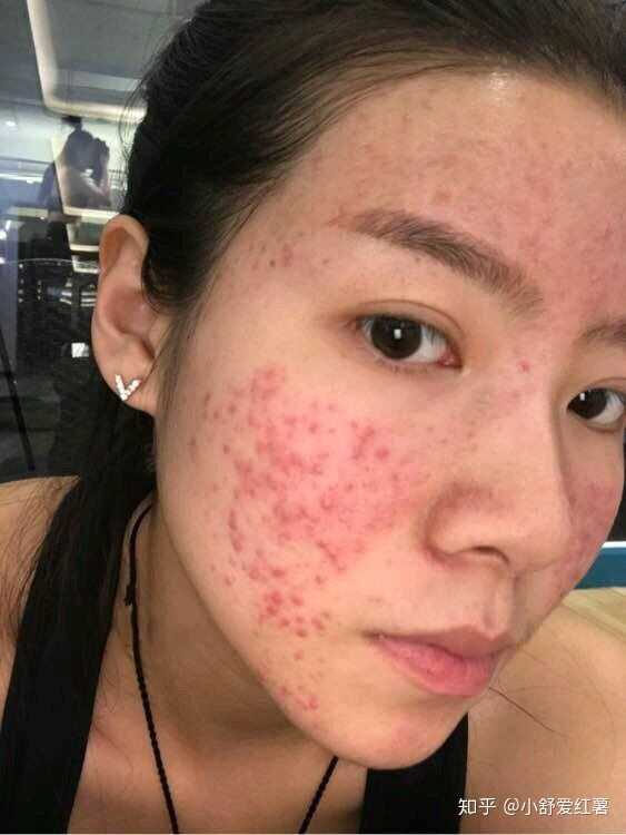 如何有效去除臉上的痘印——全方位指南，全方位指南，如何有效去除臉上痘印的方法