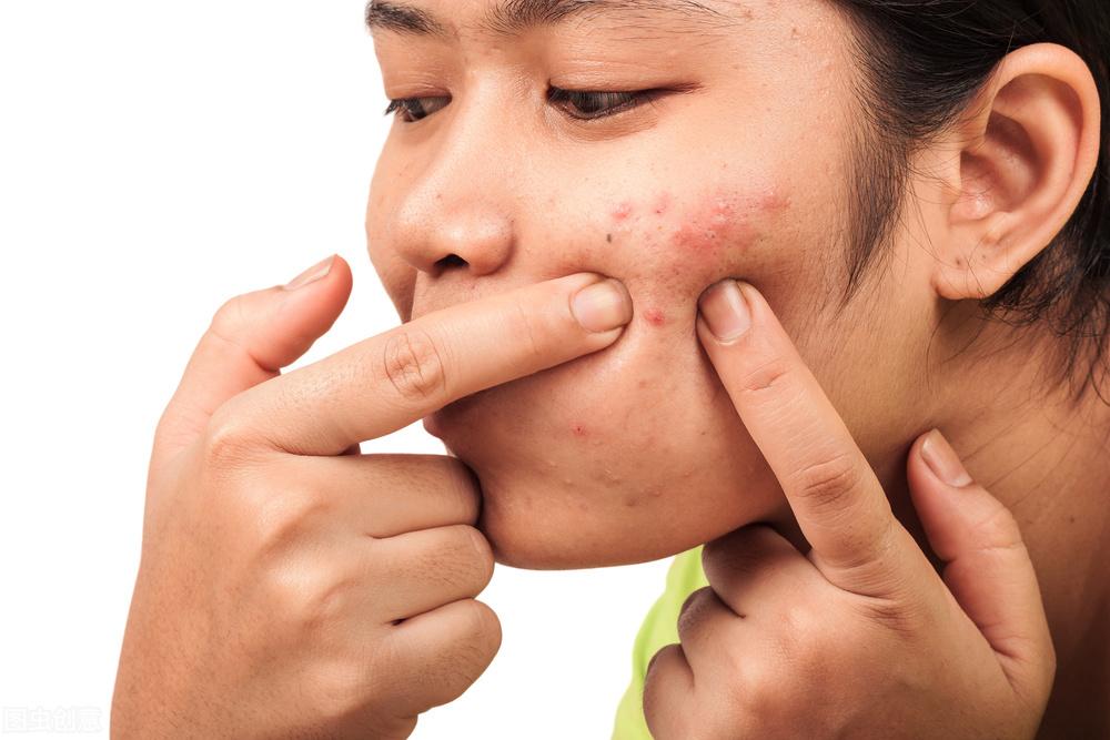 全面解析，痤瘡怎么治才能好？，全面解析，痤瘡治療的有效方法與策略