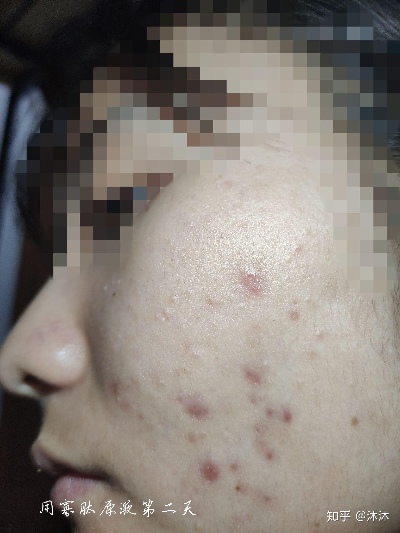 日常護(hù)理建議