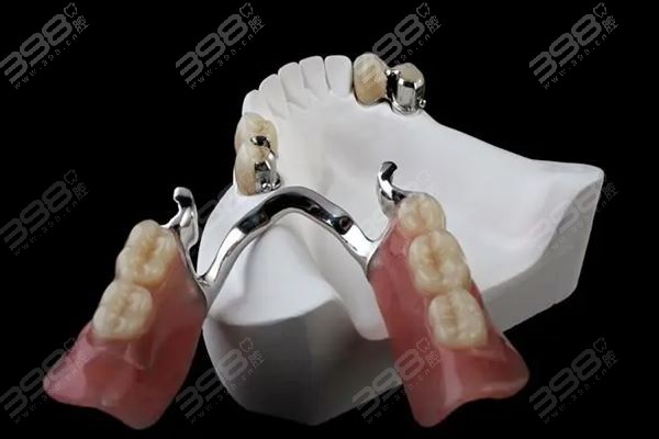 鑲一顆牙大概需要多少錢——全面解析鑲牙費用因素，鑲一顆牙的費用解析，全面探討鑲牙費用因素及大概價格