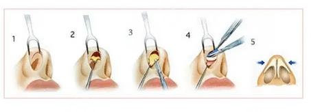 微調(diào)鼻子需要多少錢，全面解析費用因素與注意事項，微調(diào)鼻子費用全解析，費用因素與注意事項，需要多少錢？