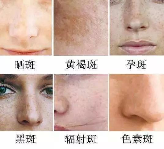 如何有效去除臉上斑點——全方位指南，全方位指南，如何有效去除臉上斑點