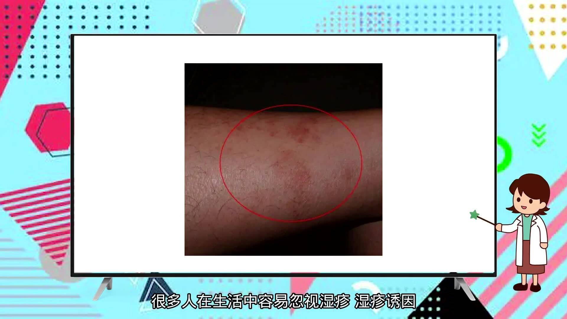 蕁麻疹夜晚止癢妙招，讓你遠離瘙癢困擾，蕁麻疹夜晚止癢小妙招，告別瘙癢煩惱