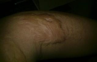 當(dāng)兵不合格的疤痕圖，解析與應(yīng)對建議，當(dāng)兵不合格疤痕圖詳解及應(yīng)對建議