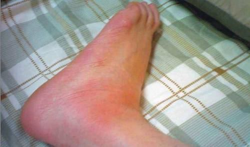 痛風(fēng)發(fā)作如何快速止痛消腫——痛風(fēng)患者的自救指南，痛風(fēng)發(fā)作快速止痛消腫自救指南