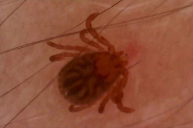 蜱蟲咬人后的癥狀及應對措施，蜱蟲咬人后的癥狀與應對措施解析